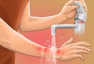 Cách sơ cứu khi bị bỏng nước sôi, dầu ăn đúng cách