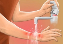 Cách sơ cứu khi bị bỏng nước sôi, dầu ăn đúng cách